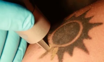 Can Any Tattoo Be Removed?