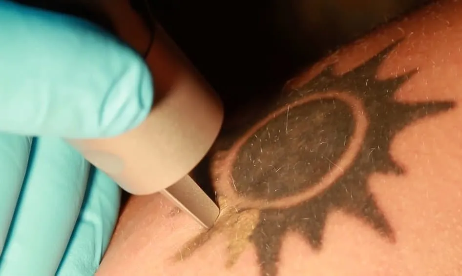 Can Any Tattoo Be Removed?