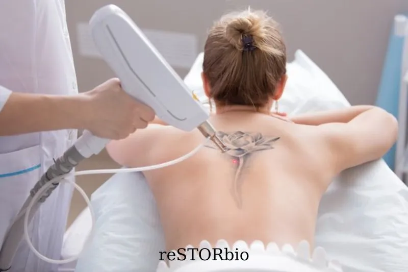After Laser Hair Removal, Is It Possible To Get A Tattoo