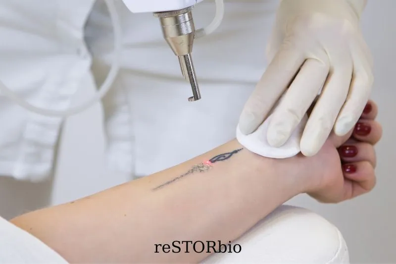 Can You Use IPL On Tattoos
