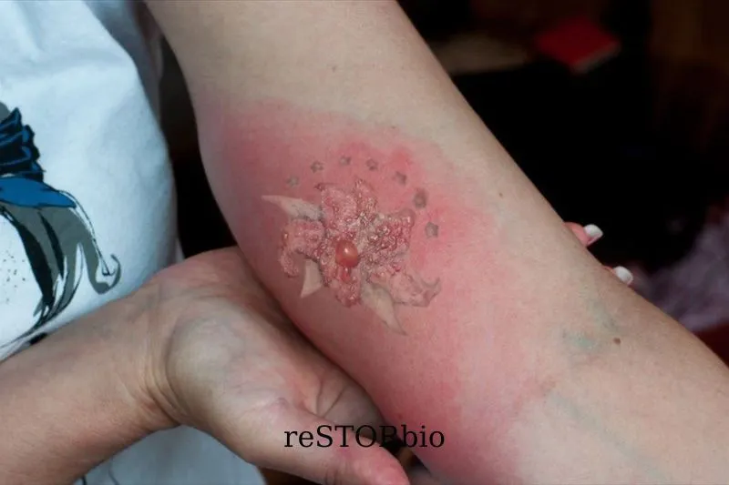 Causes of Tattoo Infection