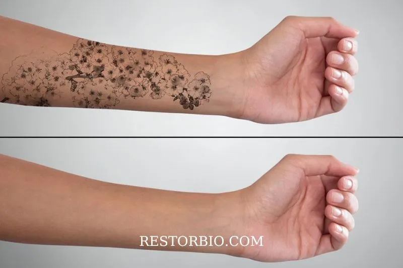 Expectations for Tattoo Removal