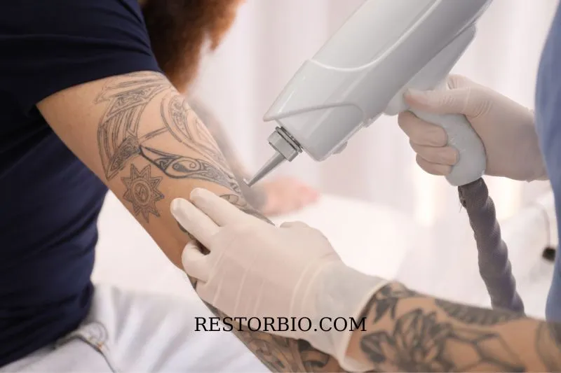 How Bad Does Tattoo Removal Hurt