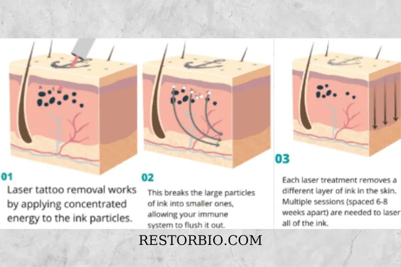 How Do Laser Tattoo Removals Work