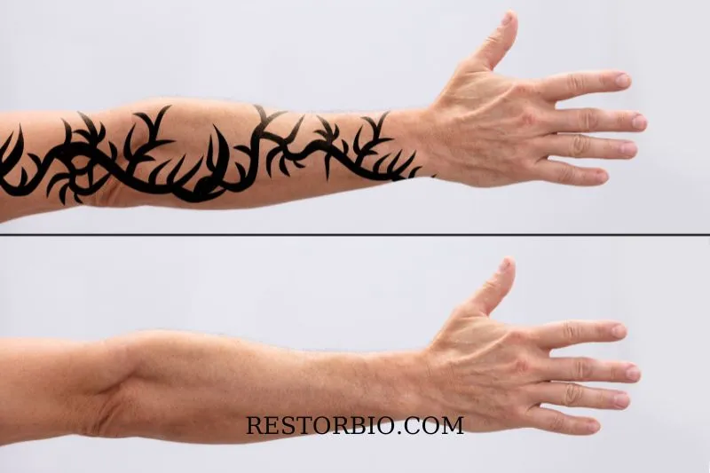 How Do Tattoo Removals Work At Home