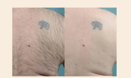 Does Laser Hair Removal Affect Tattoos?