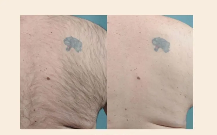 Does Laser Hair Removal Affect Tattoos?