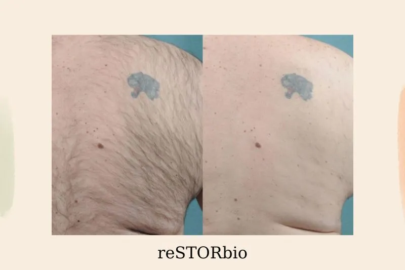 How Does Laser Hair Removal Impact Regions That Have Been Tattooed