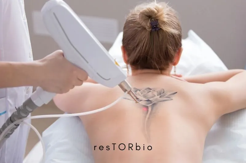 How to become a laser tattoo removal technician