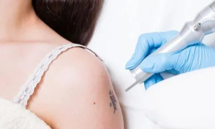How To Become A Tattoo Removalist – Do You Need A License For This Job?