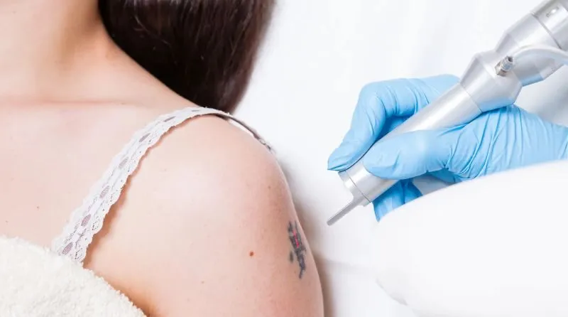 How To Become A Tattoo Removalist – Do You Need A License For This Job?
