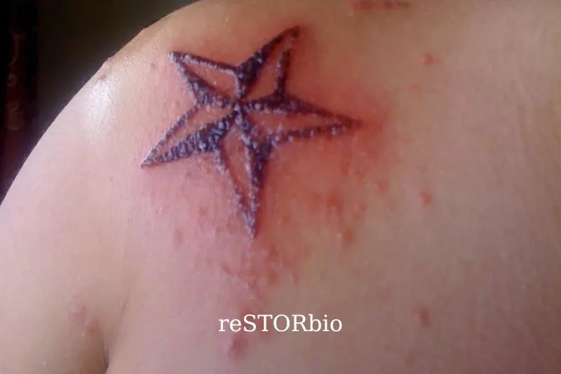 Infection Warning Signs Following Laser Tattoo Removal