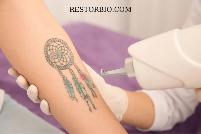 Painful Tattoo Removal Factors
