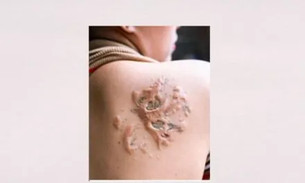 Is it OK to Tattoo Over Scars? Is it painful?