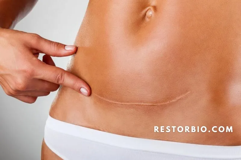 Scars on the stomach