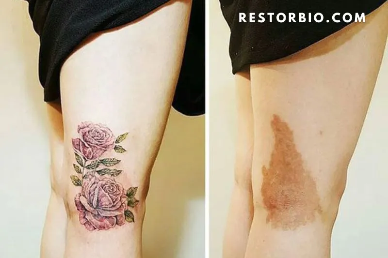 Who Should NOT Get A Scar-Covering Tattoo