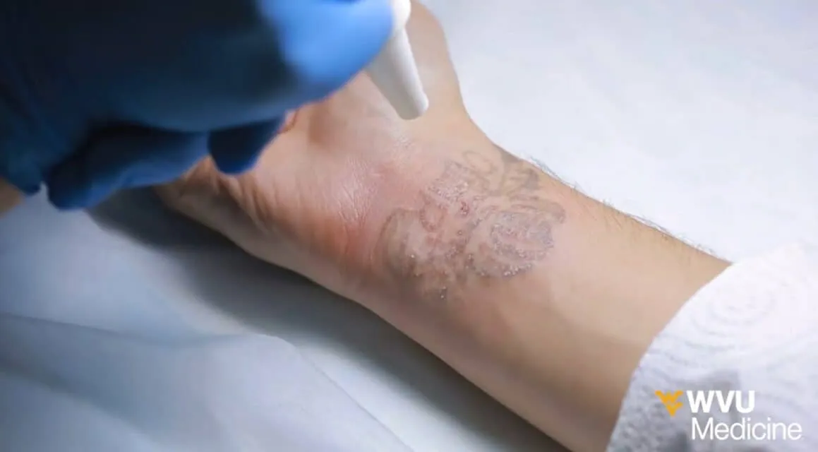 How To Remove Tattoos At Home Naturally: Best Ultimate Guide You Need To Know