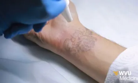 How To Remove Tattoos At Home Naturally: Best Ultimate Guide You Need To Know