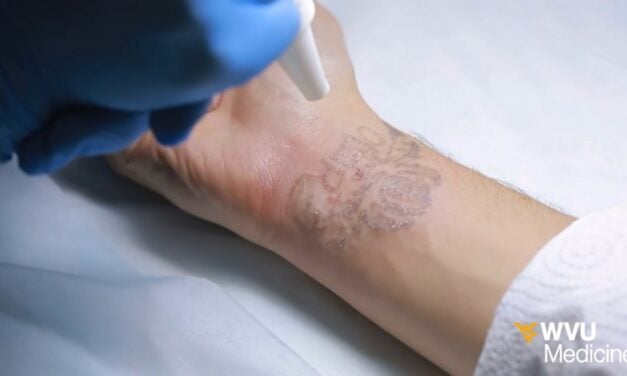 How To Remove Tattoos At Home Naturally: Best Ultimate Guide You Need To Know